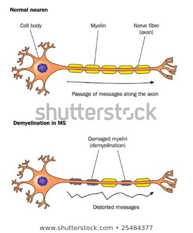 Demyelination in multiple sclerosis - labeled