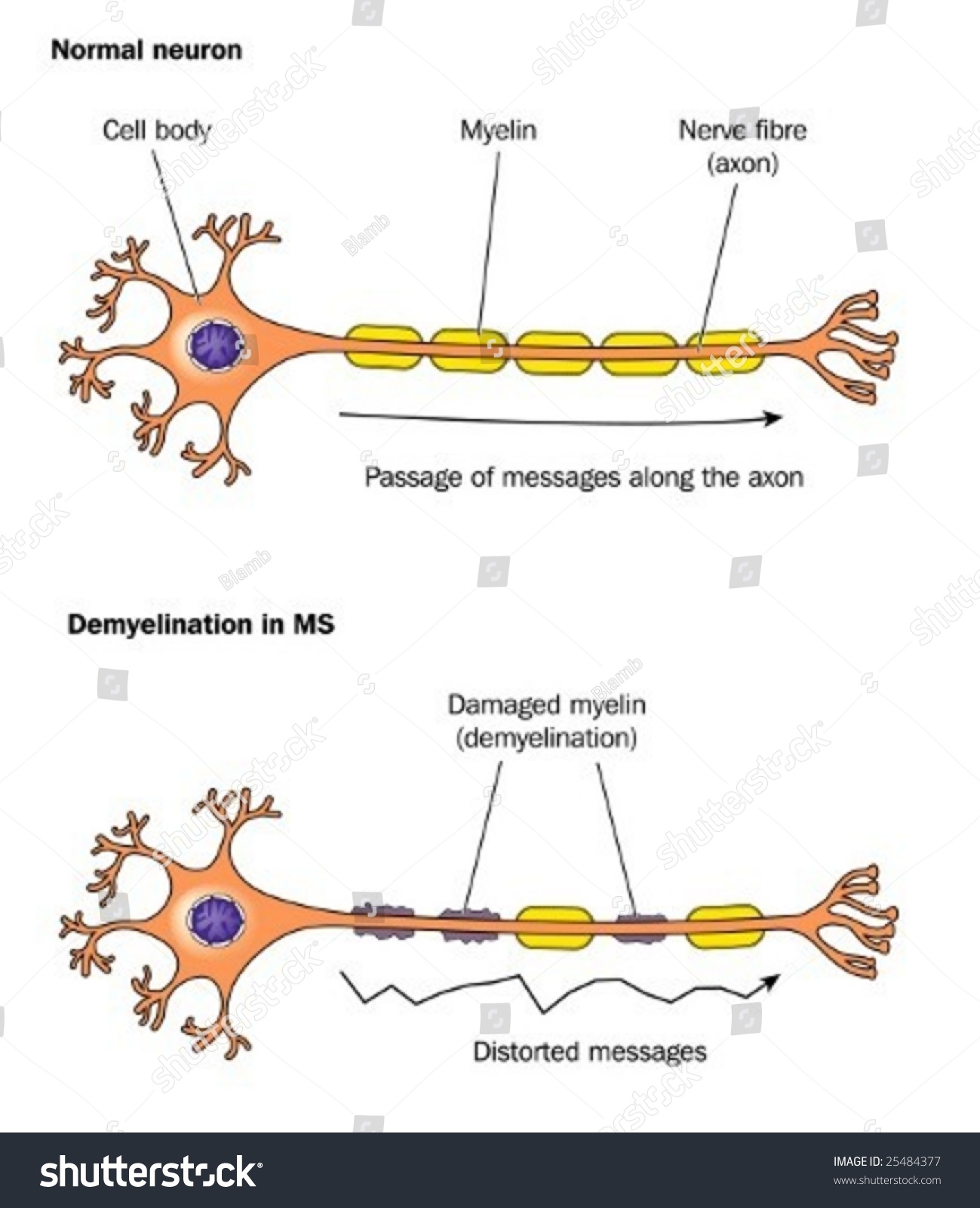 Demyelination in multiple sclerosis - labeled