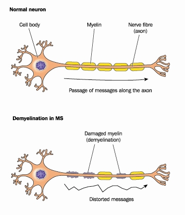 demyelinating neuron