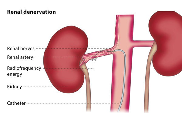 The interventional radiologist will insert a catheter into the femoral  artery in your thigh, and through this will access the arteries feeding  your kidneys.
