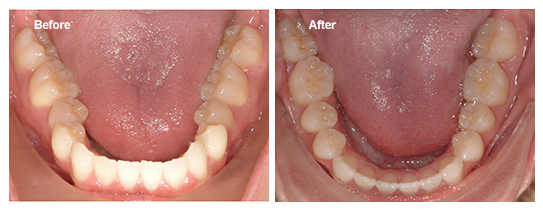 Expansion of dental arches creates space for tooth alignment.
