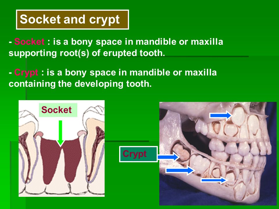 Socket Crypt Socket and crypt - Socket : is a bony space in mandible or  maxilla