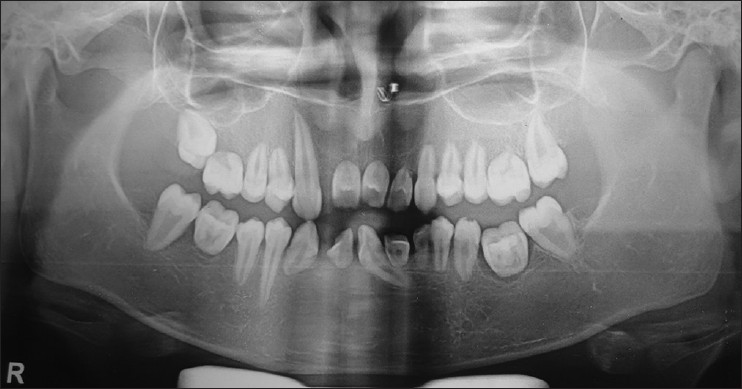 Figure 4: Panoramic radiographs exhibiting the absence of root development