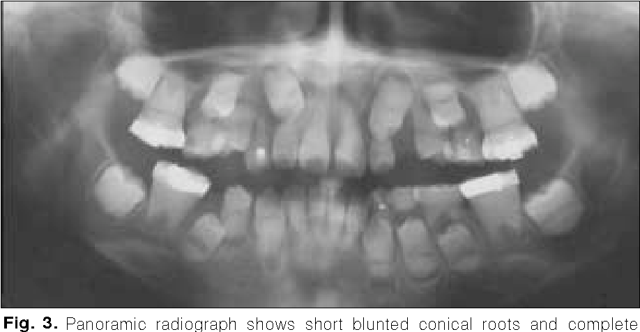 Fig. 3. Panoramic radiograph shows short blunted conical roots and complete  obliteration of the