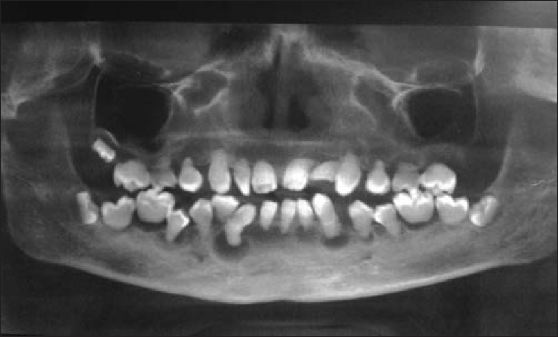 Figure 2: OPG showing teeth without pulp chamber and root