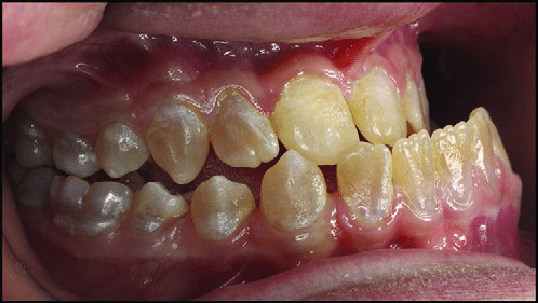 Severe Class III malocclusion with dentinogenesis imperfecta. | Download  Scientific Diagram