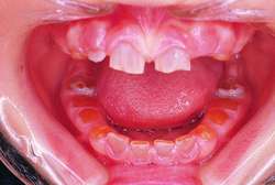 Dentinogenesis imperfecta | definition of dentinogenesis imperfecta by  Medical dictionary