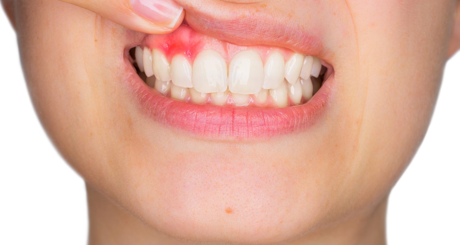 Symptoms of Dental Abscesses