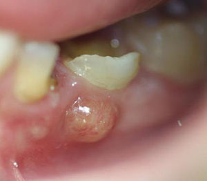 Dental abscess