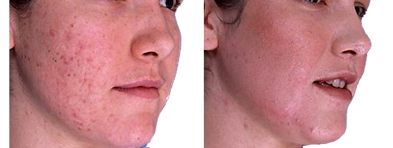 Dermabrasion, like the other two famous skin resurfacing procedures, aims  to restore the smoothness of the facial skin that has changed and has been  damaged