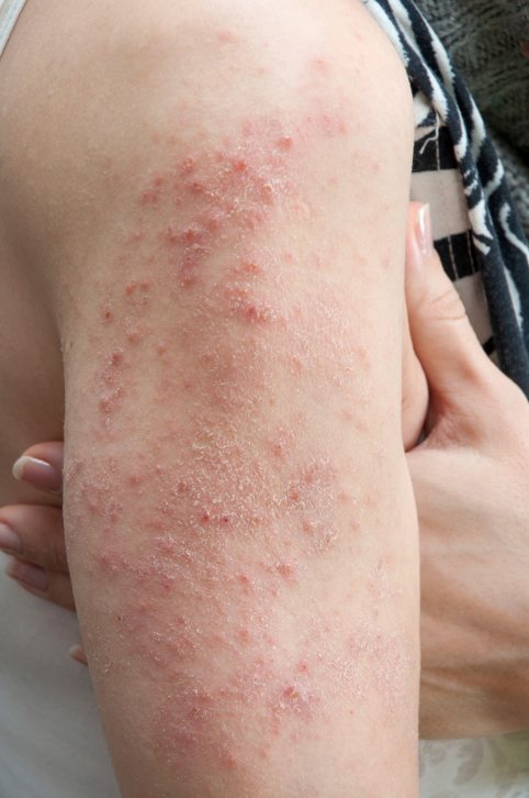 ThinkstockPhotos-462259375. Example of dermatitis herpetiformis.