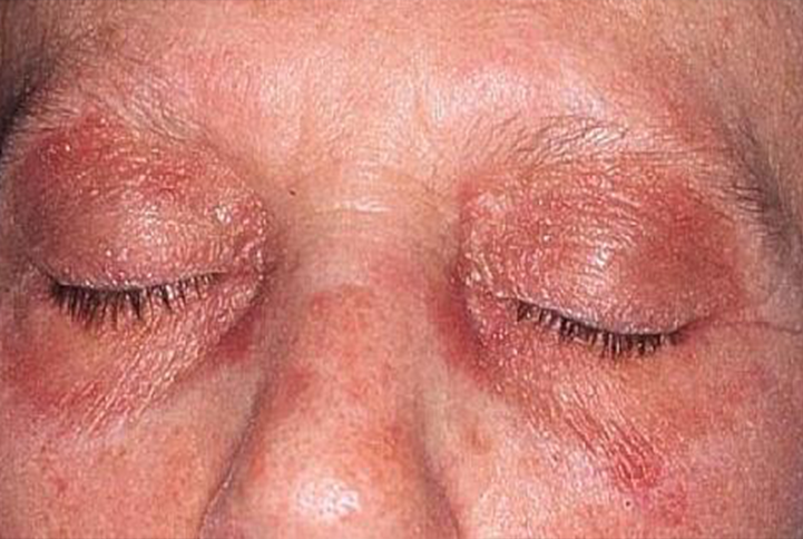 Classic Heliotrope rash shown over eyelids