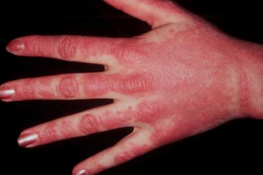 These lesions on dorsal hands demonstrate photodis
