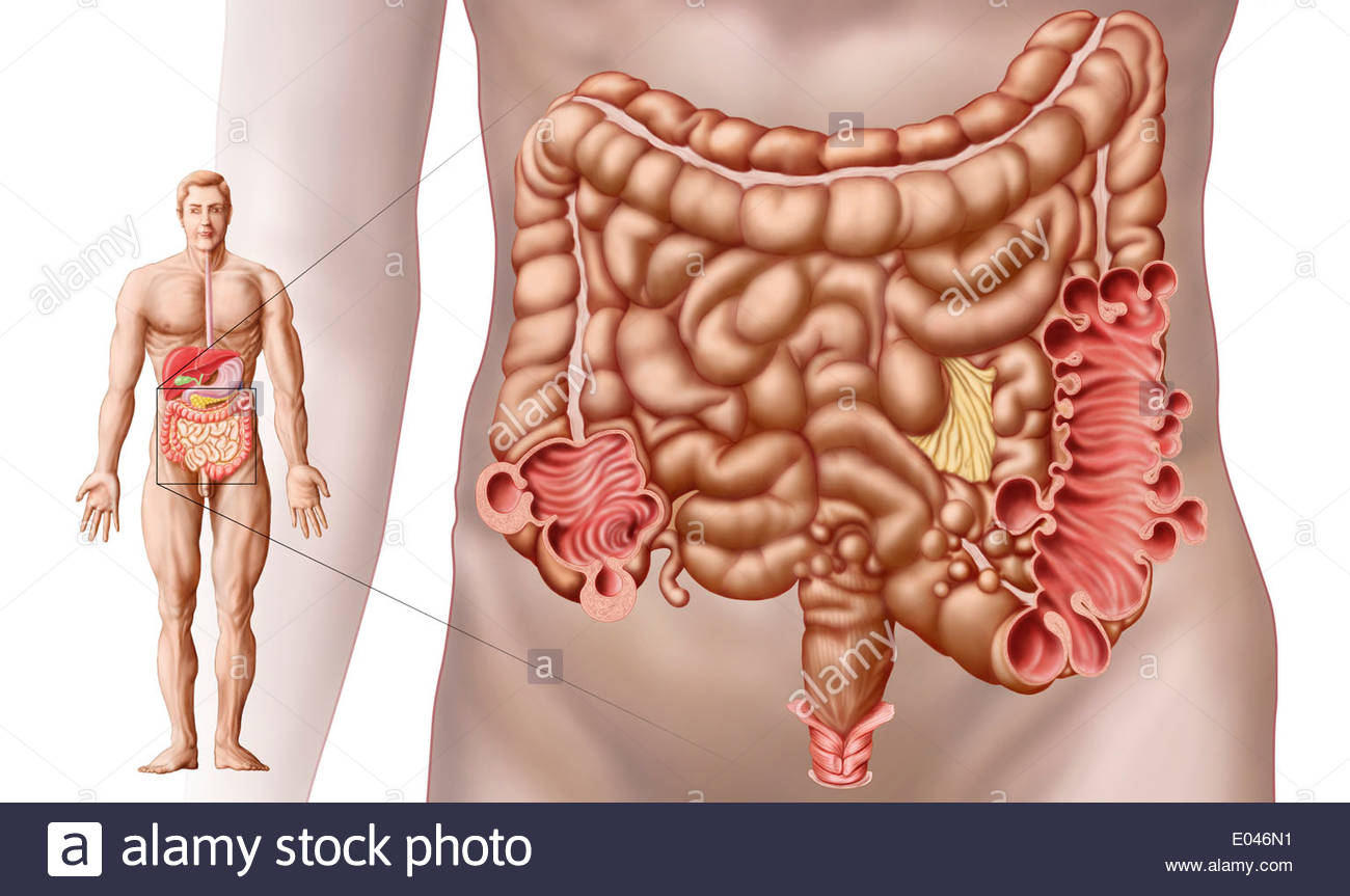 Diverticulitis in the descending colon region of the human intestine. -  Stock Image