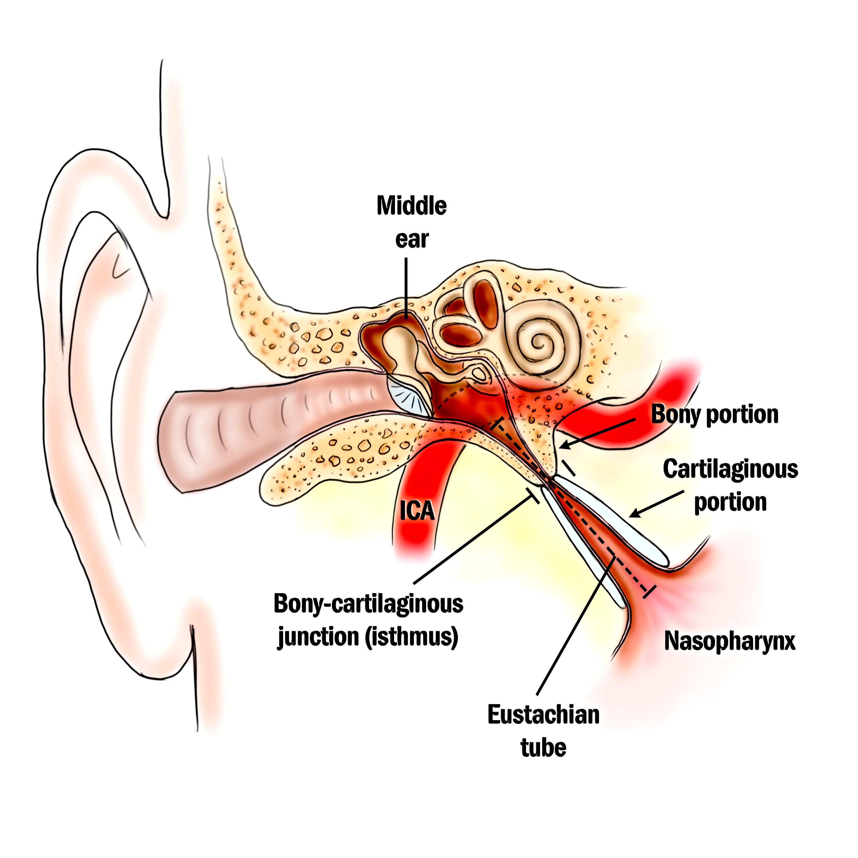 valve of the Eustachian tube to open and/or close properly ETD  (Eustachian tube dysfunction) is estimated to effect up to 5-15% of the  adult population.