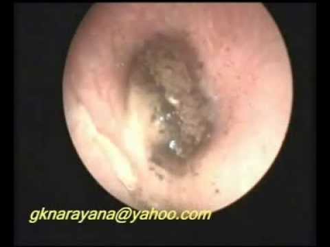 otomycosis fungal infection of ear