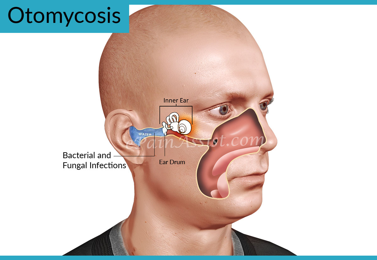 Otomycosis or Ear Fungus