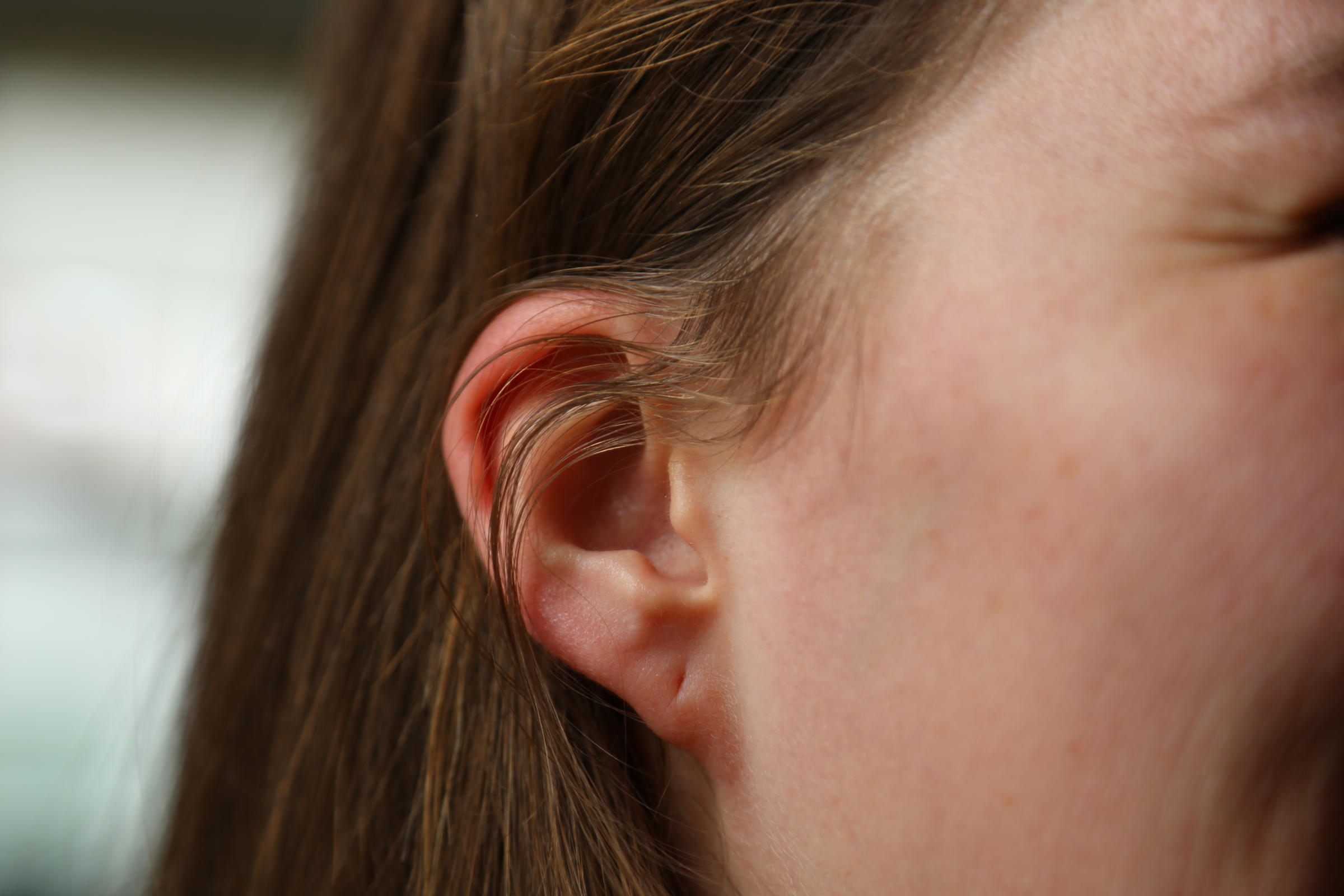 A new study from the University of Pittsburgh links ear lobe shape to  serious genetic syndromes.