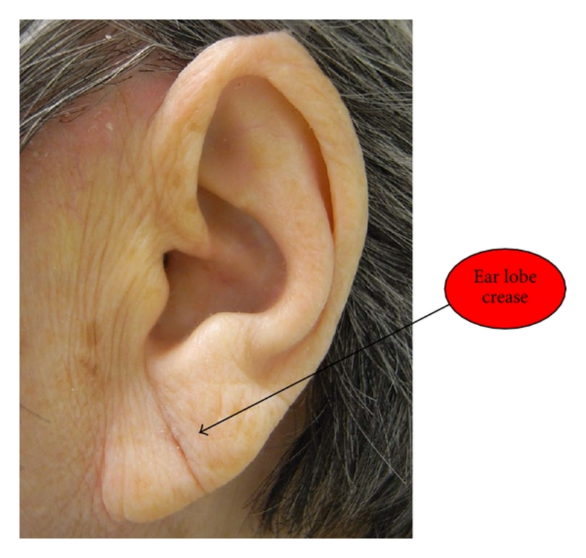 A complete ear lobe crease on the left-side of ear of a female participant