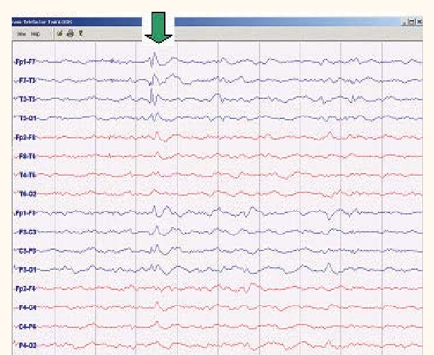 Electroencephalogram (EEG) of Case 1 with eating epilepsy (temporolimbic  type). Long