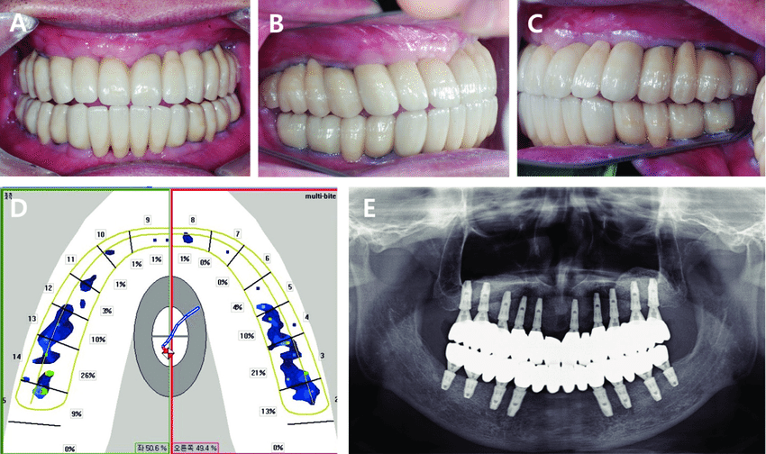 Eccentric occlusion with definitive prosthesis. (A) Anterior movement:  posterior teeth of both side were disoccluded, (B) Lateral movement-right  side: group