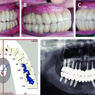 Eccentric occlusion with definitive prosthesis. (A) Anterior movement:  posterior teeth of both