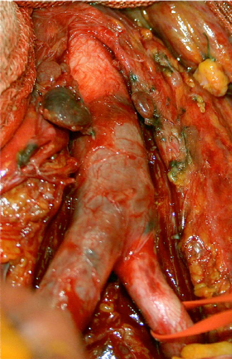 Ecchymotic appearance of the aortic wall below inferior mesenteric artery  (IMA) level and of