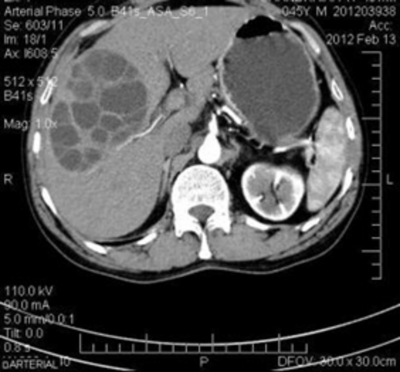 Figure 5: CT scan showing hydatid cyst in the right lobe of liver with  multiple daughter cysts, filled with stroma and not containing any fluid.