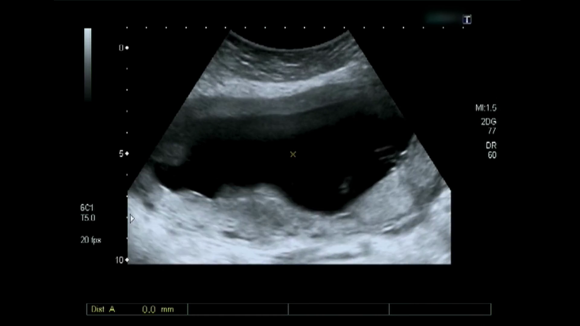 Ultrasound echography of third month fetus Stock Video Footage -  Storyblocks Video