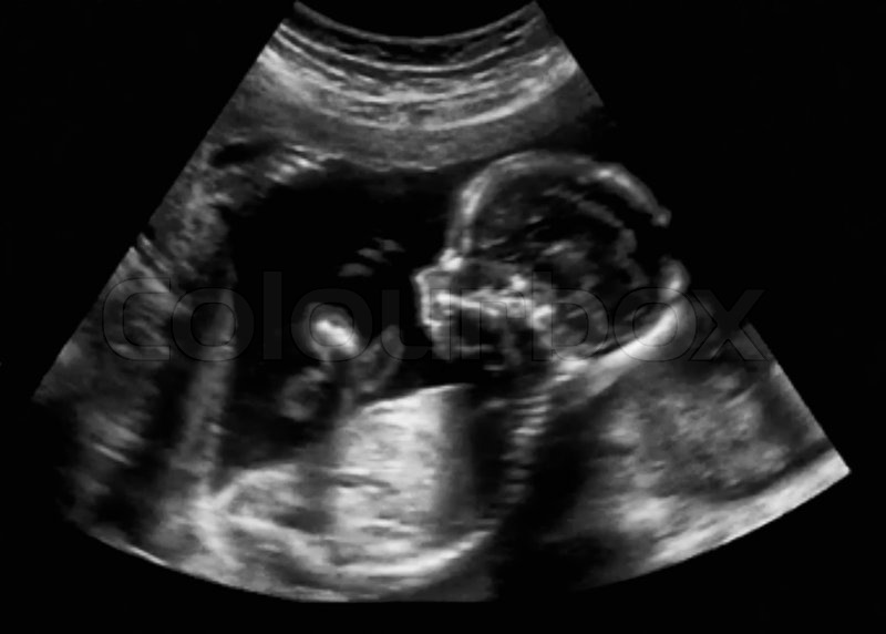 Obstetric Ultrasonography Ultrasound Echography of a first months fetus,  stock photo