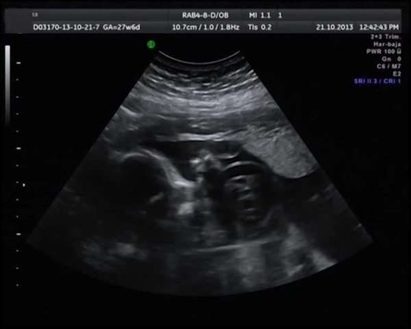 Echography the Ultrasound. Medical ultrasound scan of human embryo - Stock  Video Footage - Dissolve