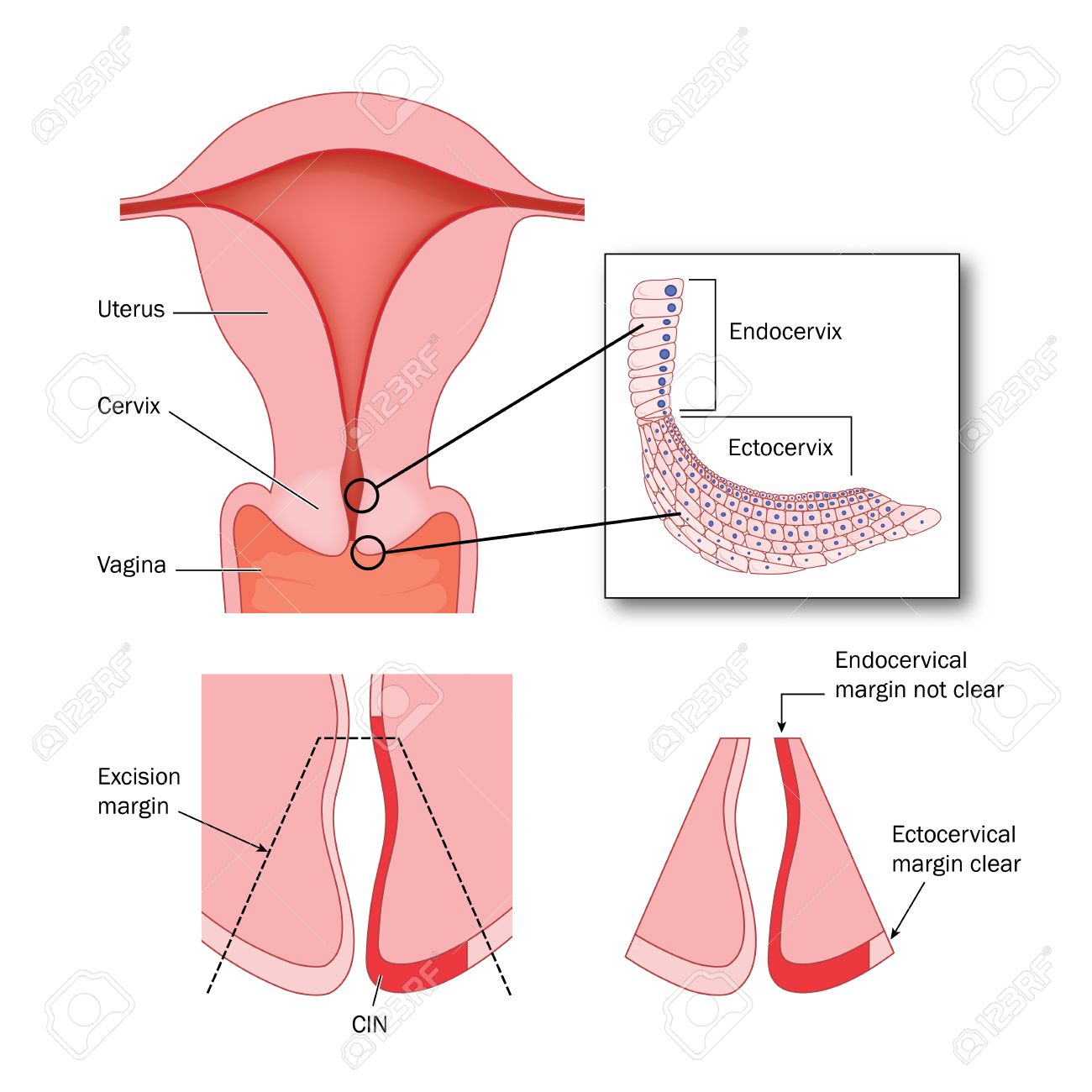Cono biopsia del cuello del útero para eliminar las áreas de células  anormales en el ectocérvix