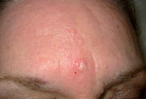 Picture of Sebaceous Hyperplasia