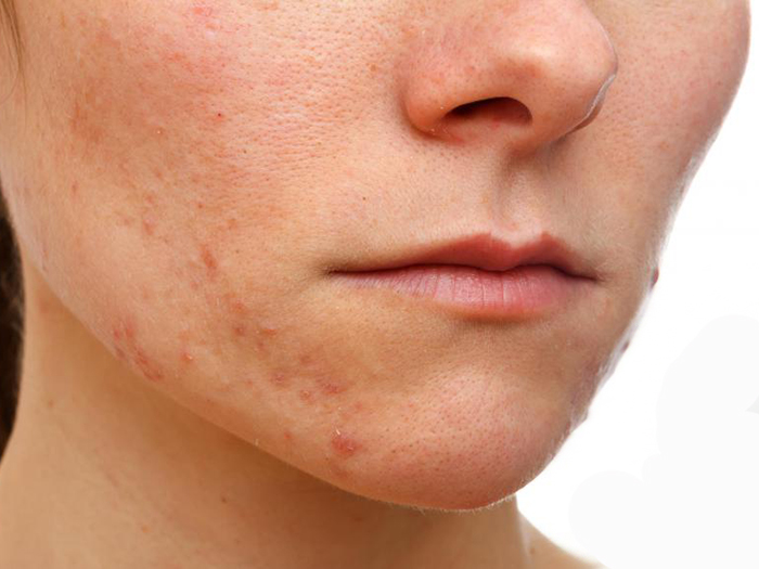 Facial Eczema – How to Get rid of Eczema on Face?
