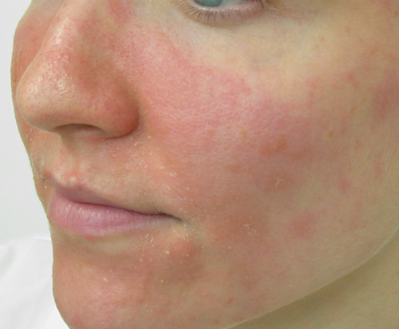 facial eczema