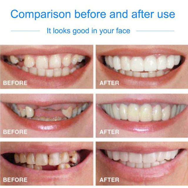 Drop Ship Smile Dental Vaneer Fit Flex Teeth with Box Fits Snap on False  Teeth Upper