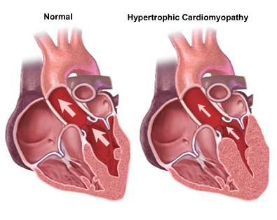 Illustrations of hearts showing a normal and a hypertrophic cardiomyopathy  heart