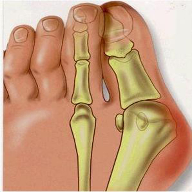 1Pair Bunion Orthotics Toe Separator Ectropion Hallux Valgus Orthopedic  Braces Bone Thumb Finger Splint Health Care Massage-in Foot Care Tool from  Beauty