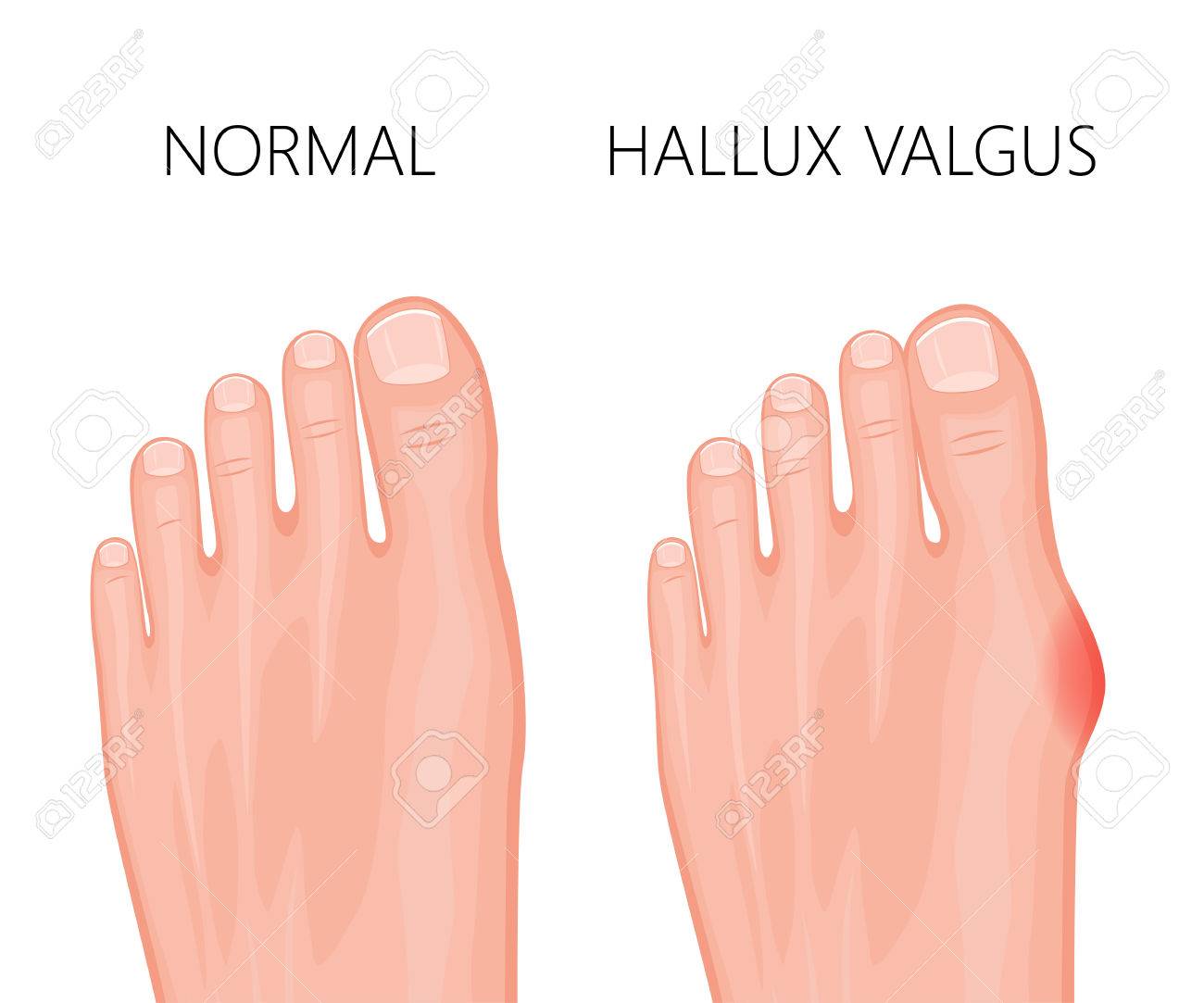 Human foot deformity hallux valgus. Used: gradient, transparency, blend  mode. Stock