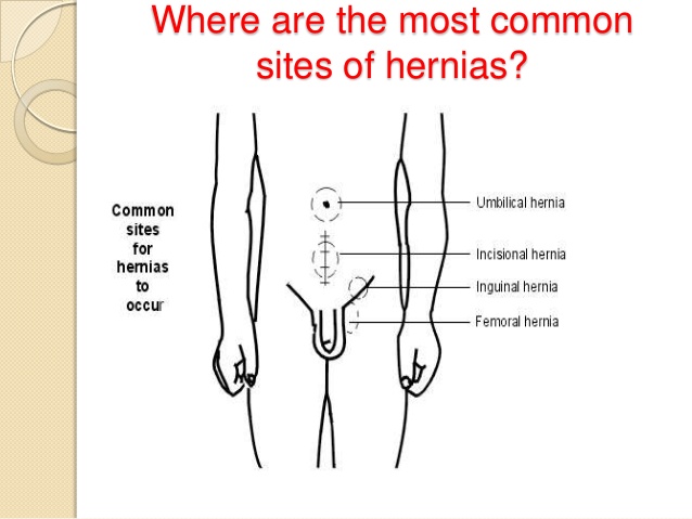Where are the most common sites of hernias?