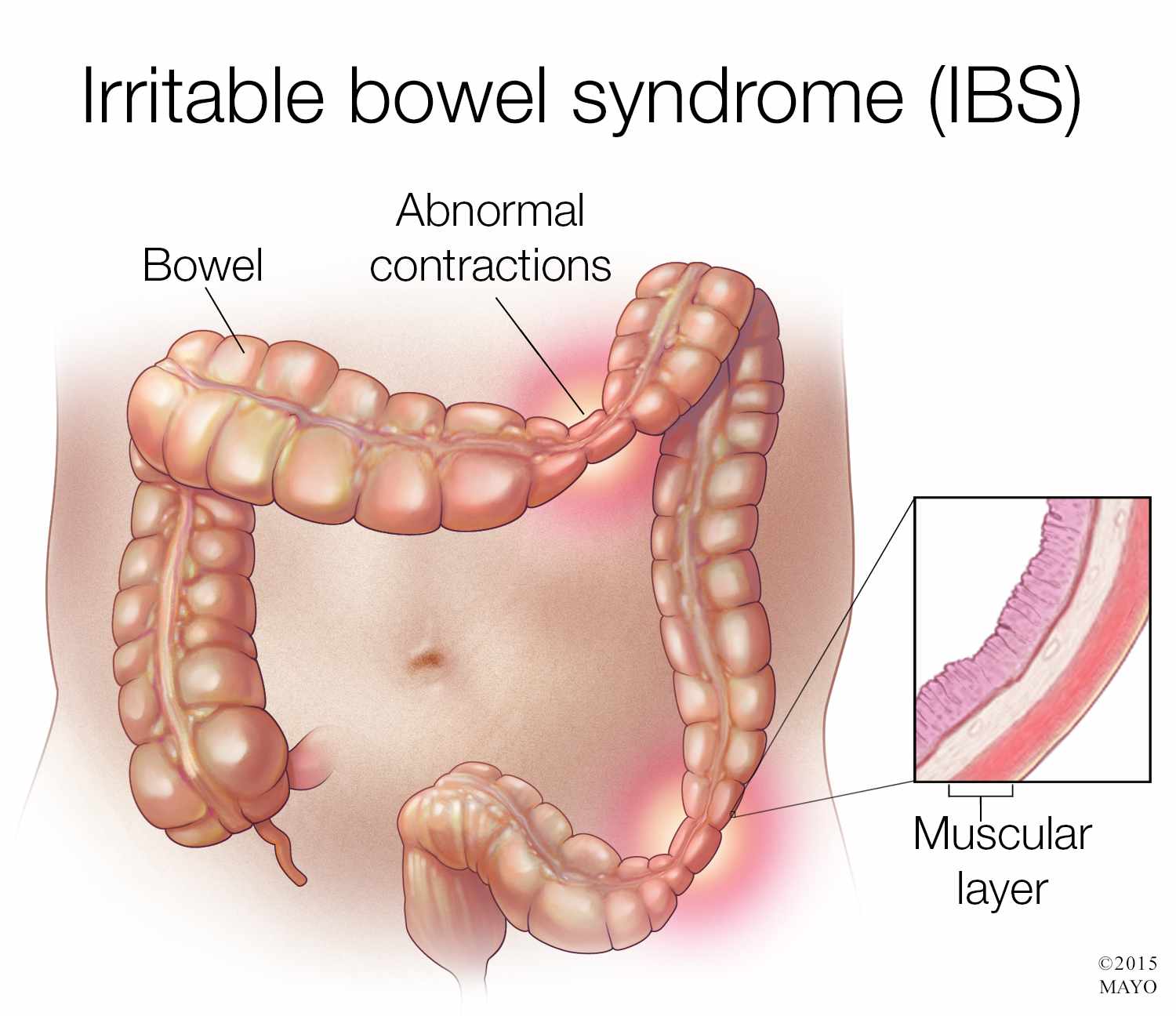 medical illustration for irritable bowel syndrome IBS