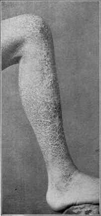 ichthyosis sauroderma