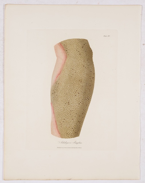 Bateman, Thomas =: Ichthyosis simplex.