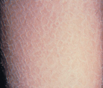 Ichthyosis vulgaris with typical fishlike scales.