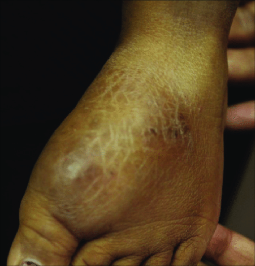Bony swelling on right foot with ichthyotic changes of skin Figure 4: Bony  swelling over