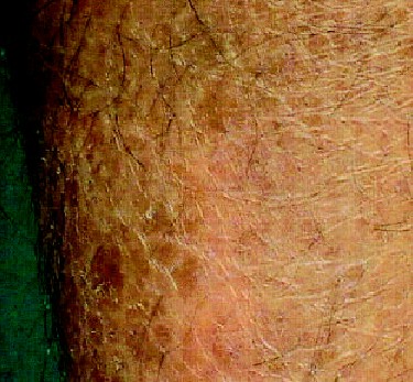 ichthyotic patches over the legs [Figure-1],
