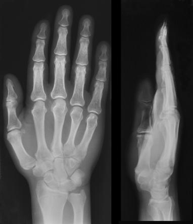 Hypertrophic osteoarthropathy | Radiology Reference Article |  Traveller Location