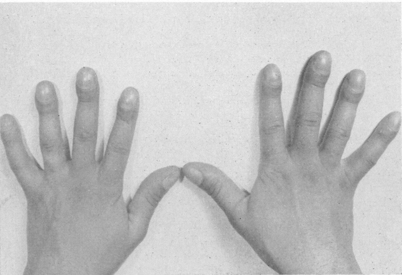 Marked Clubbing of Fingers in Patient with Chronic Idiopathic Hypertrophic  Osteoarthropathy.