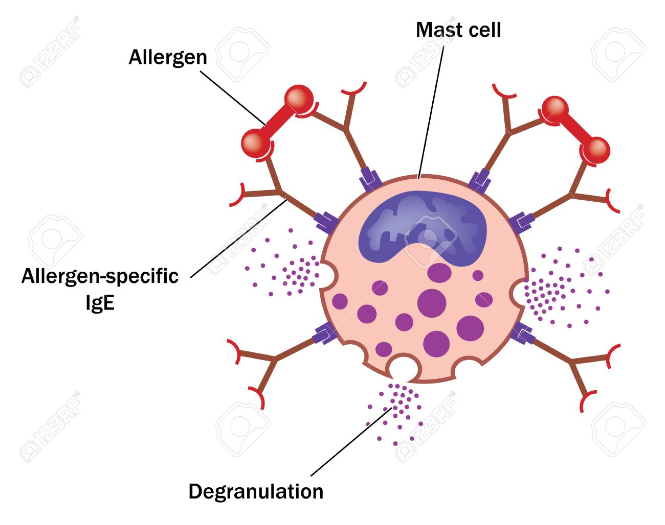 Alérgeno unido a IgE específica del alérgeno en un mastocitos dando como  resultado la desgranulación de