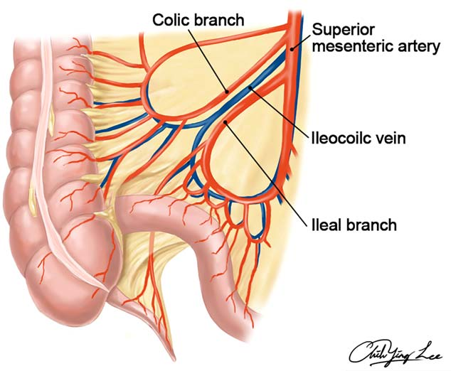 Absence of the ileocolic artery: Microsurgical implications in  reconstruction of the esophagus with the free ileocolon flap. - Semantic  Scholar